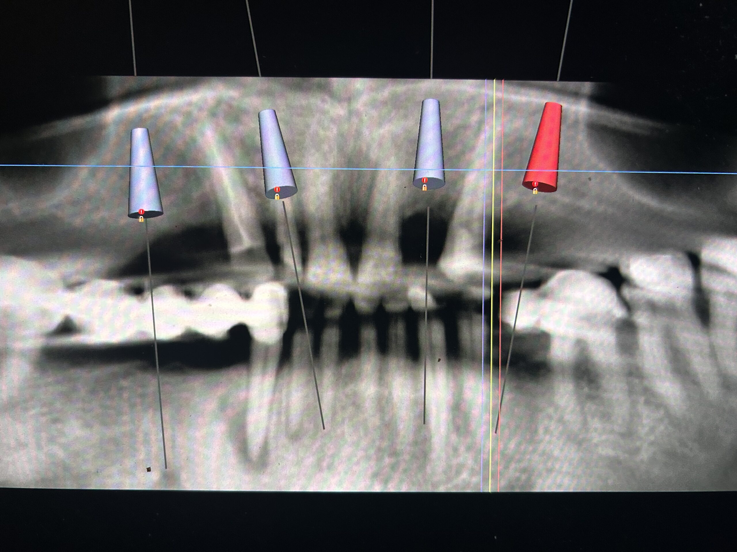 Cyfrowe planowanie pozycji czterech implantów przed zabiegiem z użyciem szablonu chirurgicznego