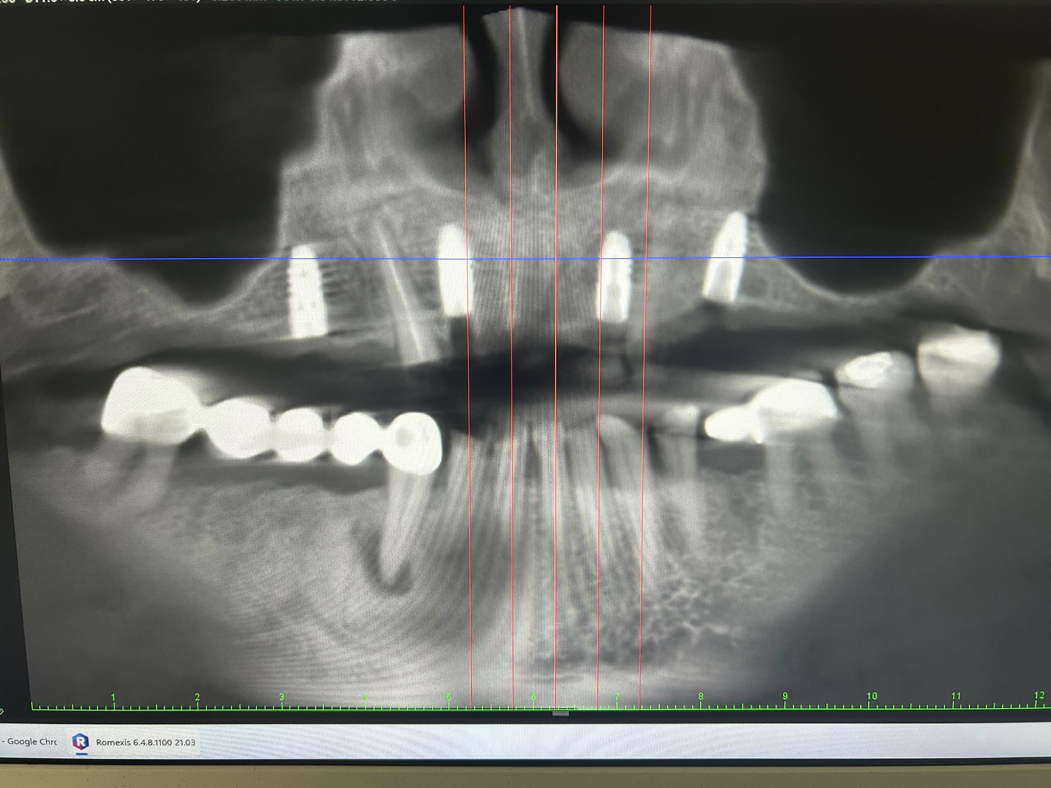 Kontrolne RTG po wszczepieniu czterech implantów z wykorzystaniem szablonu chirurgicznego